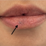Venous Lake Lip Treatment Before & After Patient #1708
