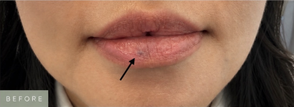 Venous Lake Lip Treatment Before & After Patient #1708