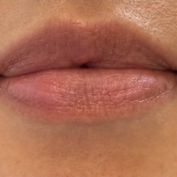 Venous Lake Lip Treatment Before & After Patient #1708