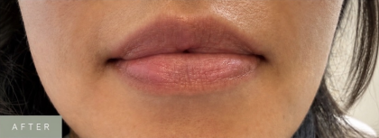 Venous Lake Lip Treatment Before & After Patient #1708